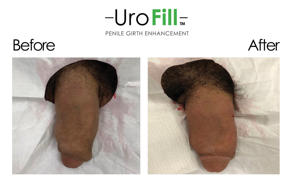 Before and After UroFill™