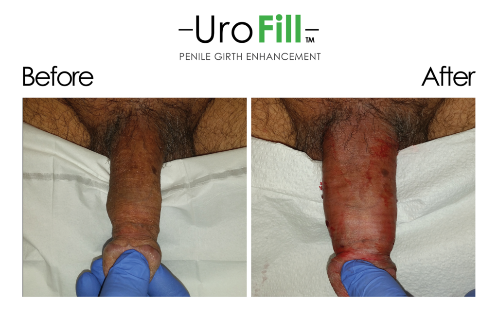 Before and After UroFill™