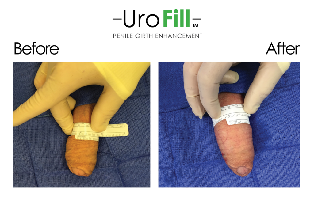 UroFill Before and After